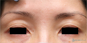 プレミアムPRP皮膚再生療法_Before