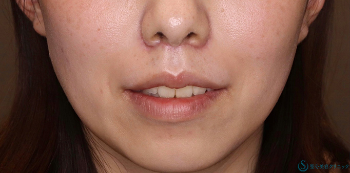 鼻下短縮術（リップリフト/人中短縮）_After