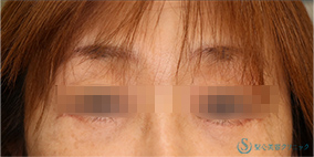 下眼瞼切開術/下眼瞼除皺術/ハムラ法_After