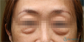 下眼瞼切開術/下眼瞼除皺術/ハムラ法_Before