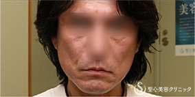 プレミアムミニリフト_After