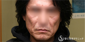 プレミアムミニリフト_Before