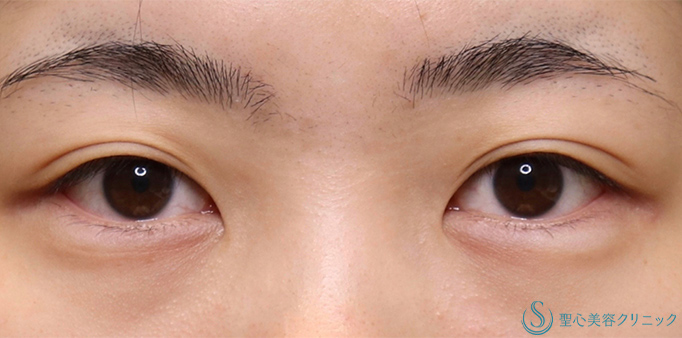 二重術（切開法）部分切開/全切開_Before