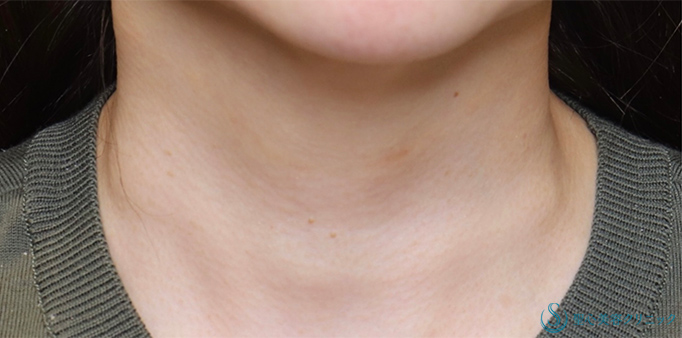 プレミアムPRP皮膚再生療法_After