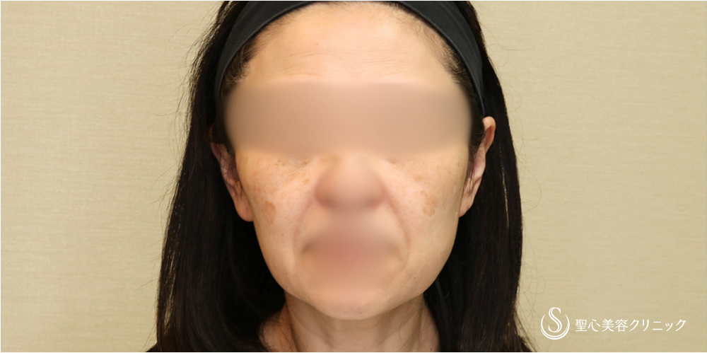 フェイスリフト_Before