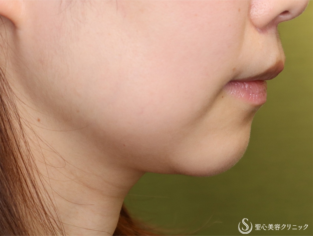 鼻下短縮術（リップリフト/人中短縮）_After