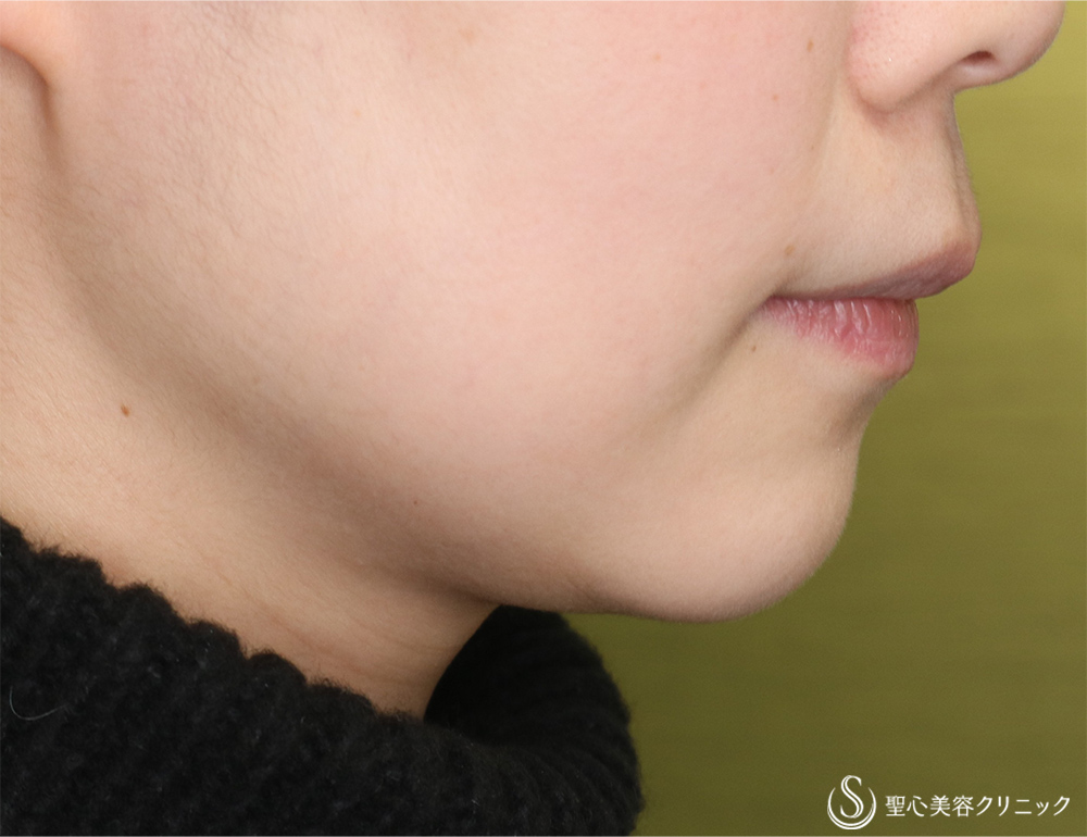 鼻下短縮術（リップリフト/人中短縮）_Before