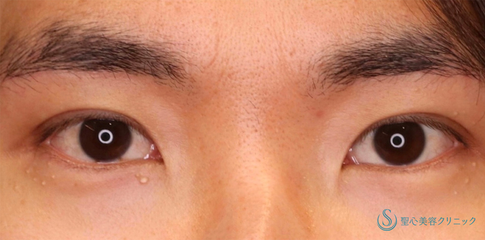 眉下切開法（眉下リフト）＋ 二重術（埋没法）：マイクロメソッド+α_After