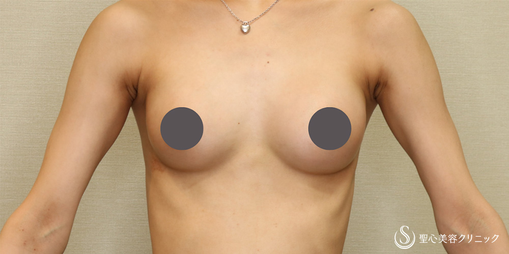 バッグプロテーゼ挿入法_After