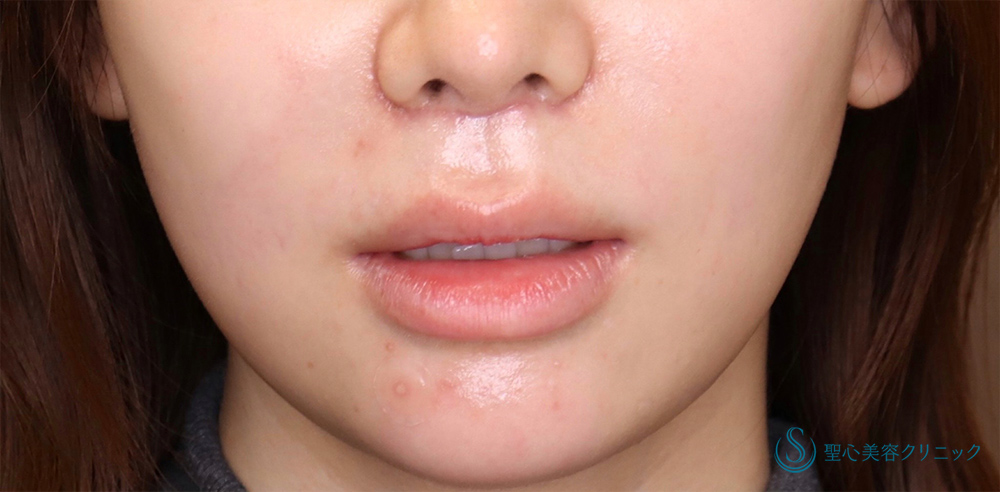 鼻下短縮術（リップリフト/人中短縮）_After