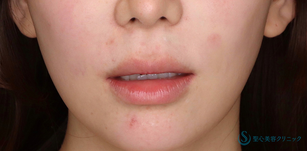 鼻下短縮術（リップリフト/人中短縮）_Before