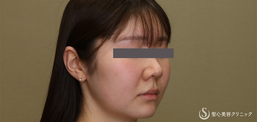 脂肪吸引注射_After