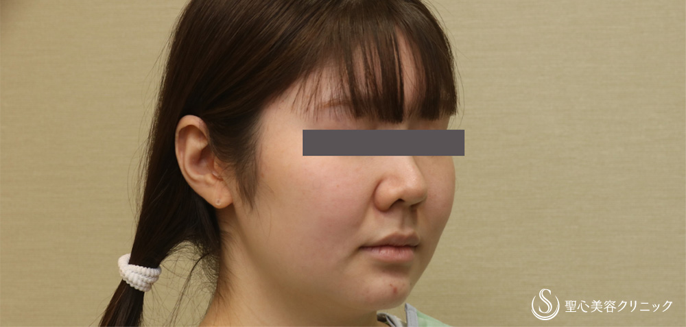 脂肪吸引注射_Before