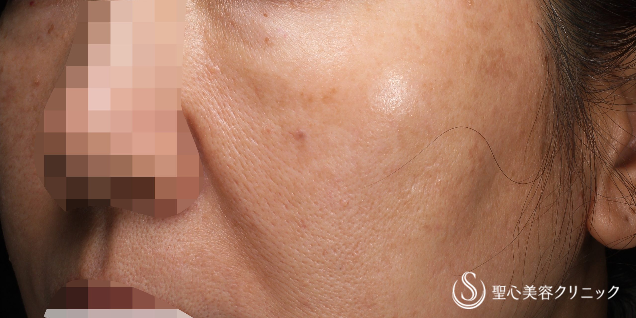 CellecV（セレックV）_シミ＋ レタッチピール_After