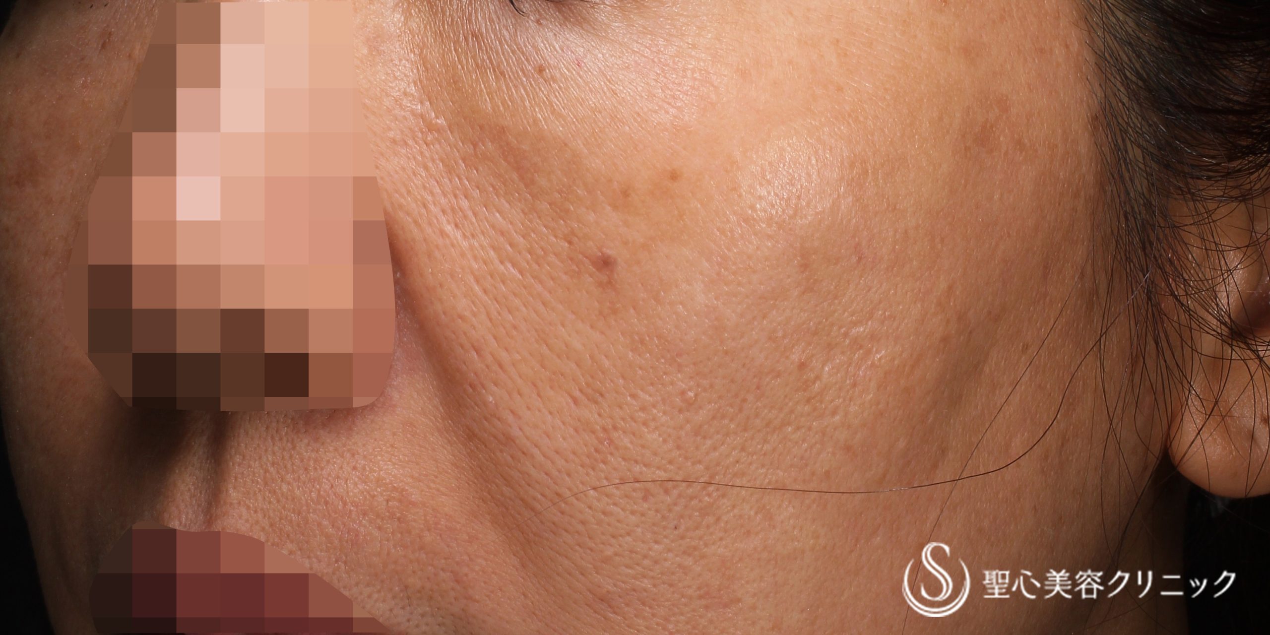 CellecV（セレックV）_シミ＋ レタッチピール_Beofre