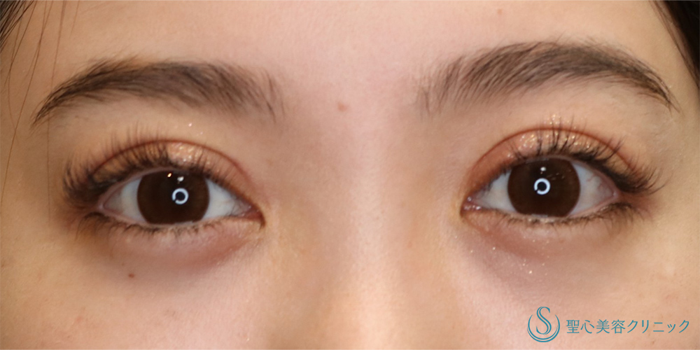 二重術（切開法）部分切開/全切開_After