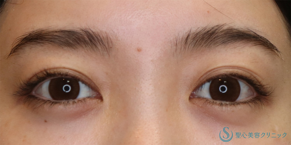 二重術（切開法）部分切開/全切開_Before