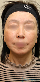 フェイスリフト_After