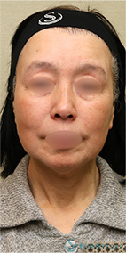 フェイスリフト_Before