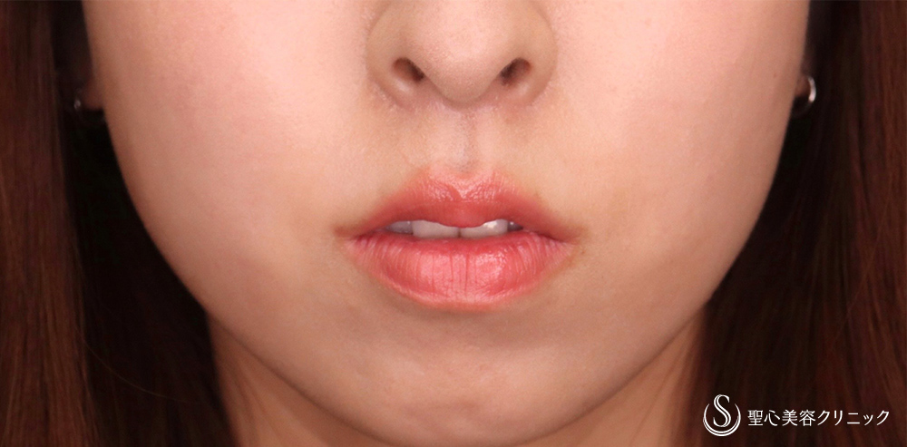 鼻下短縮術（リップリフト/人中短縮）_After