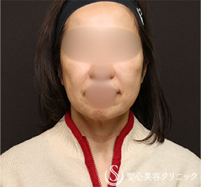 フェイスリフト_Before