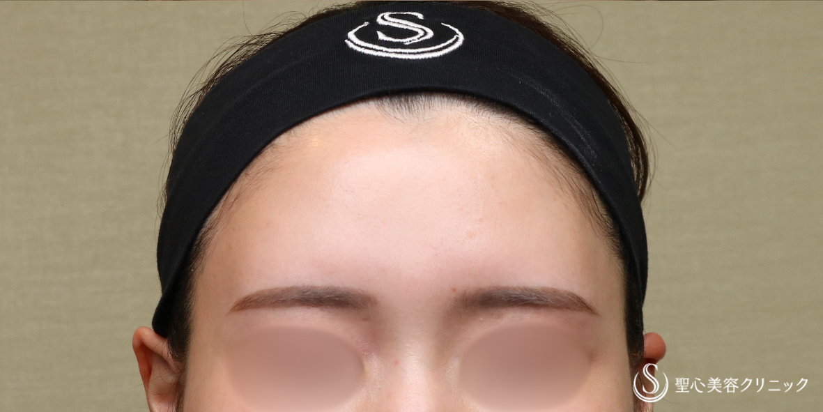 プレミアムPRP皮膚再生療法_After