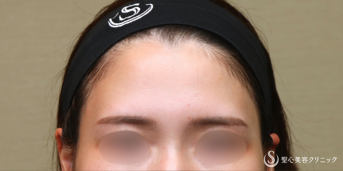 プレミアムPRP皮膚再生療法_Before