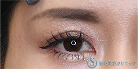 二重埋没法（マイクロメソッド+α）_After