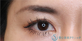 二重埋没法（マイクロメソッド+α）_Before