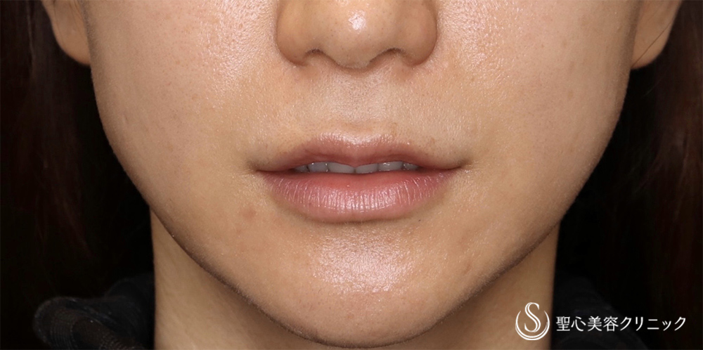 鼻下短縮術（リップリフト/人中短縮）_Before