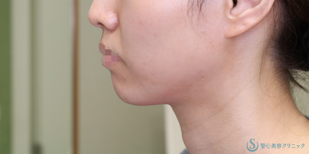 ヒアルロン酸注入（あご）_After