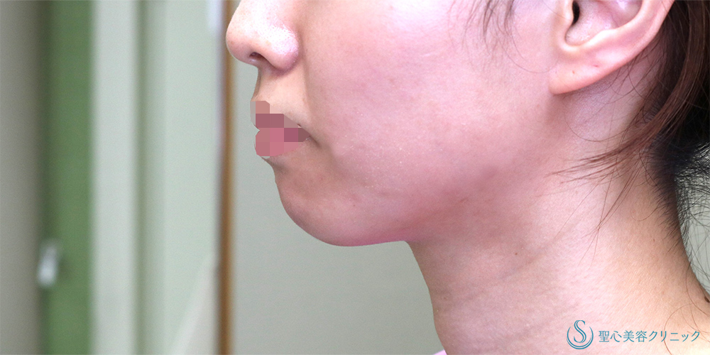 ヒアルロン酸注入（あご）_Before