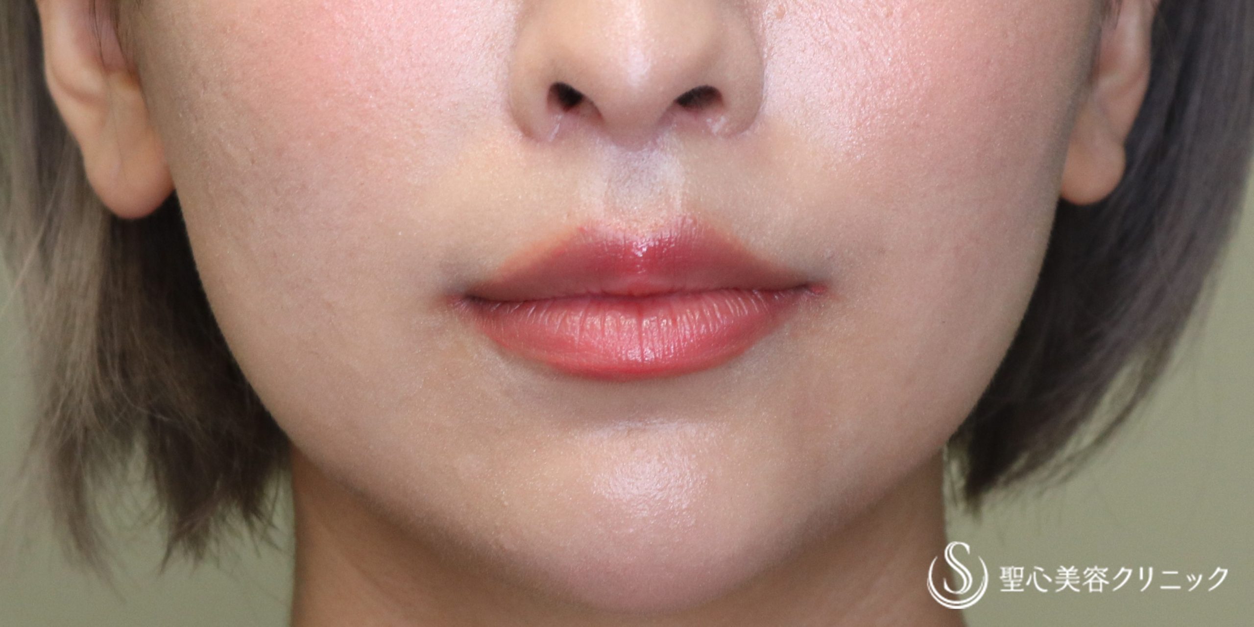 鼻下短縮術（リップリフト/人中短縮）_After