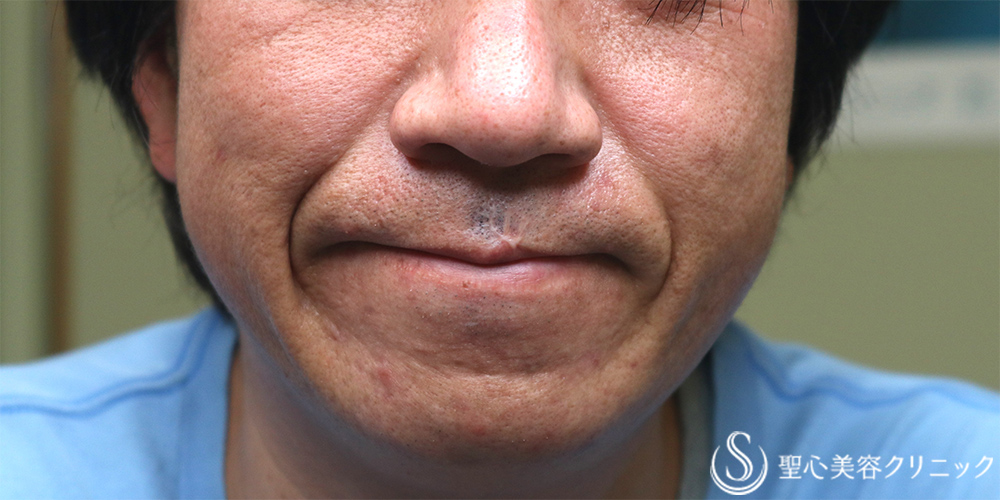 PRP皮膚再生療法_Before