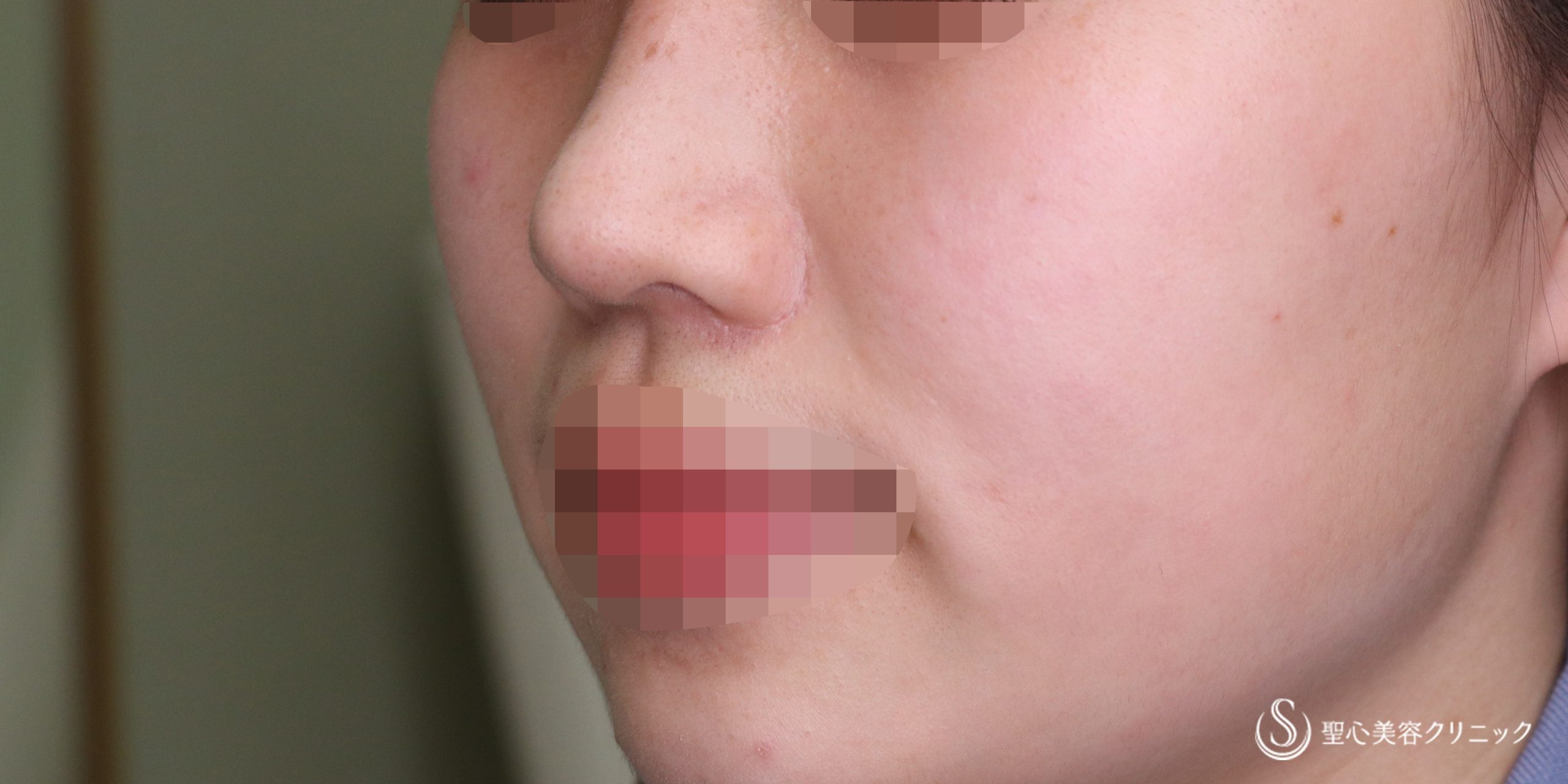 小鼻縮小_After
