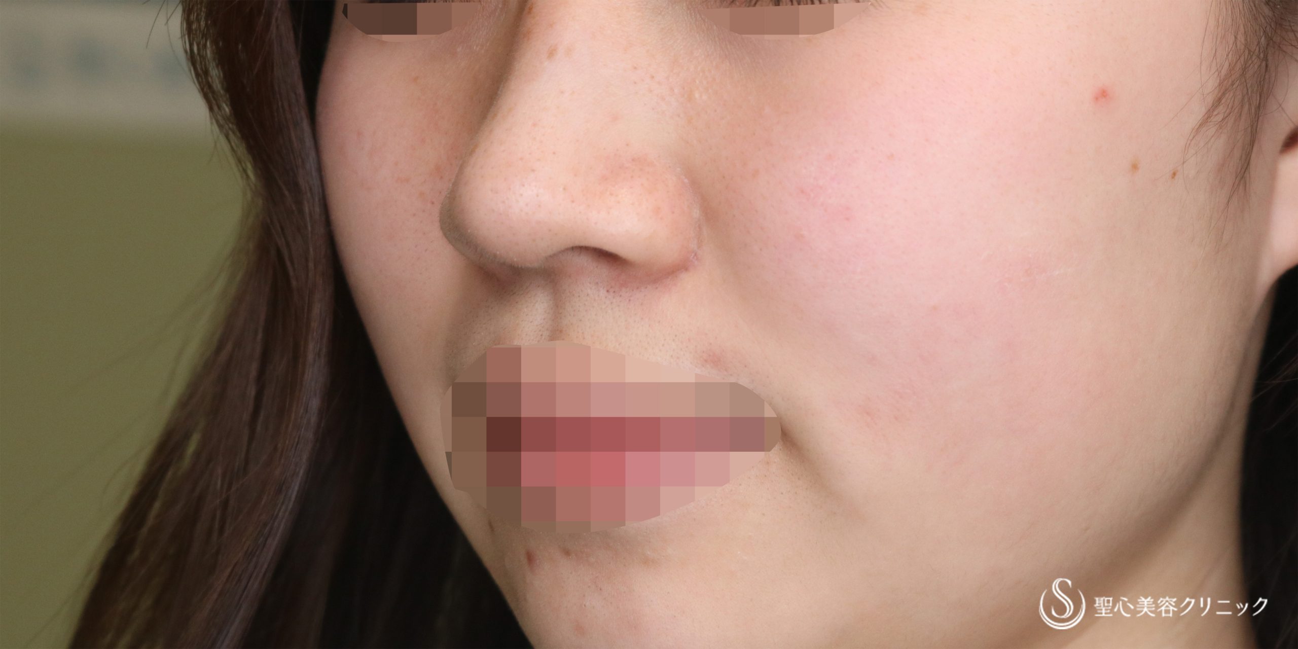 小鼻縮小_Before