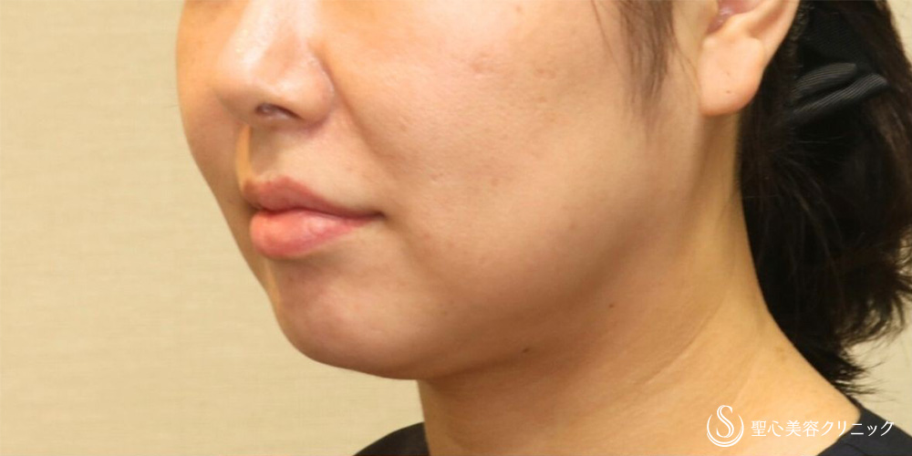 脂肪吸引注射（頬＋顎）_Before