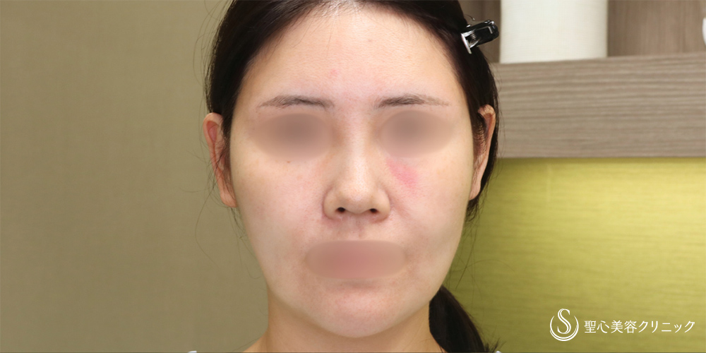 アンカーMAX_Before