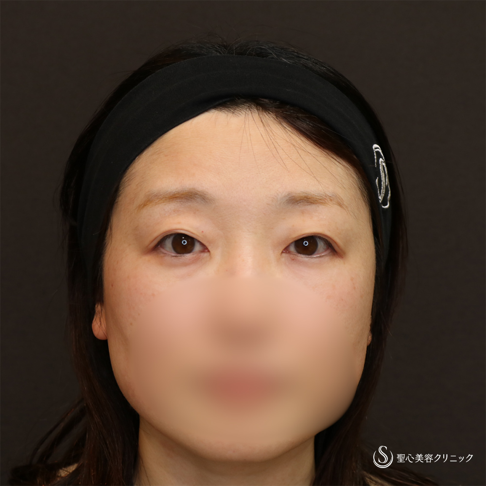 二重術（切開法）部分切開/全切開＋脱脂_Before