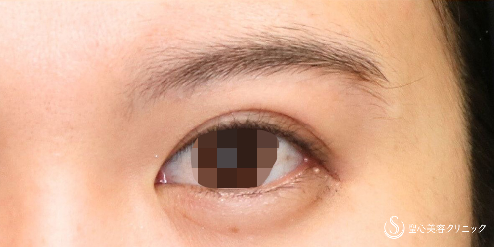 眉下切開法（眉下リフト）_After