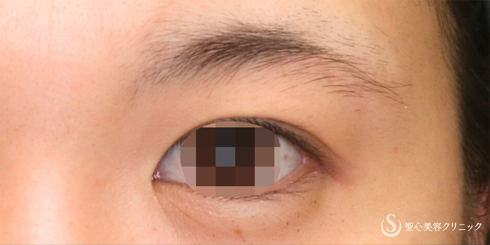 眉下切開法（眉下リフト）_Before