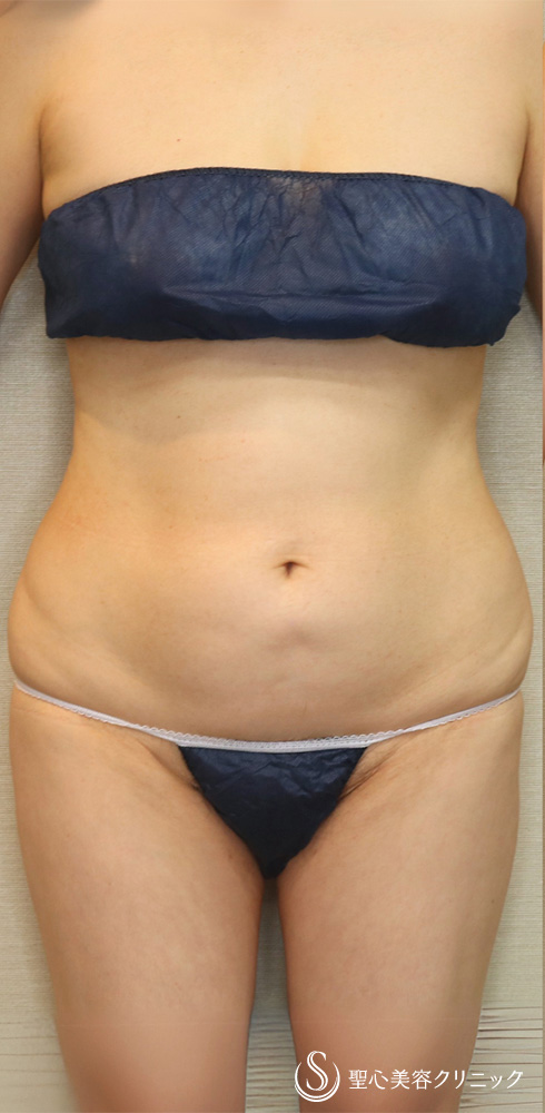 脂肪吸引（腹部全周）_Before