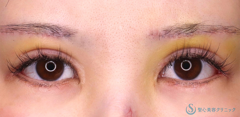 目尻切開＋眉下切開法（眉下リフト）＋ 睫毛上皮膚切開_After