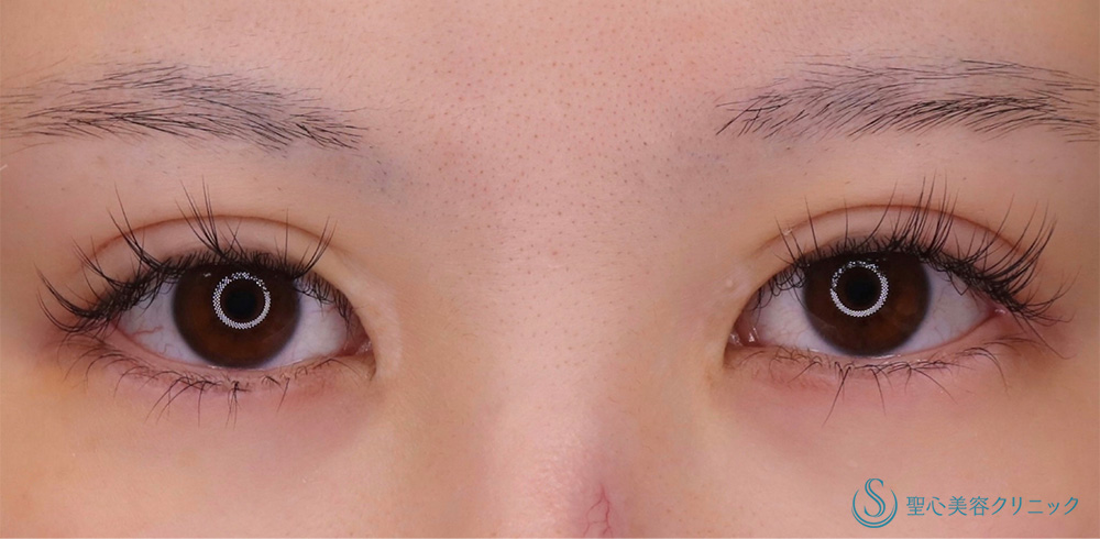 目尻切開＋眉下切開法（眉下リフト）＋ 睫毛上皮膚切開_Before